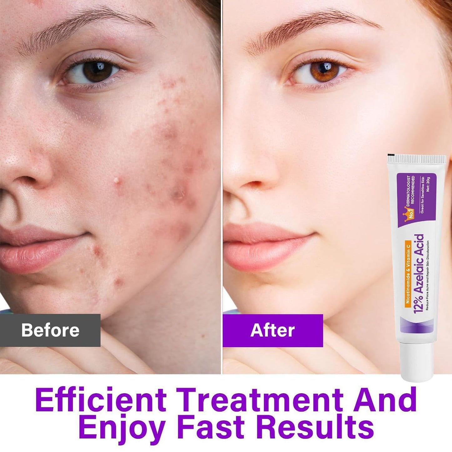 Cross-border E-commerce Azelaic Acid 12% Azelaic Acid Essence Nicotinamide Soothes Skin And Brightens Skin Color